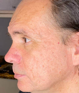 Mans Face After Procell Microchanneling Treatment