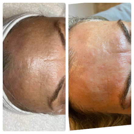 Forehead Lines on Woman's Face Before and After Plasma Pen Fibroblast Treatment