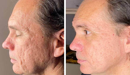 Procell Microchanneling Treatment Before and After